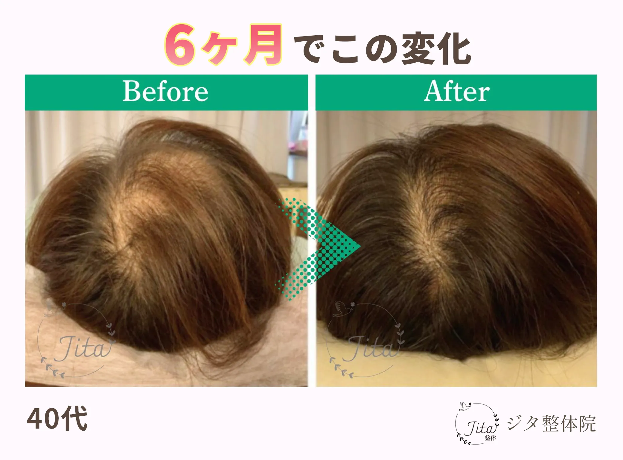 育毛施術のビフォーアフター