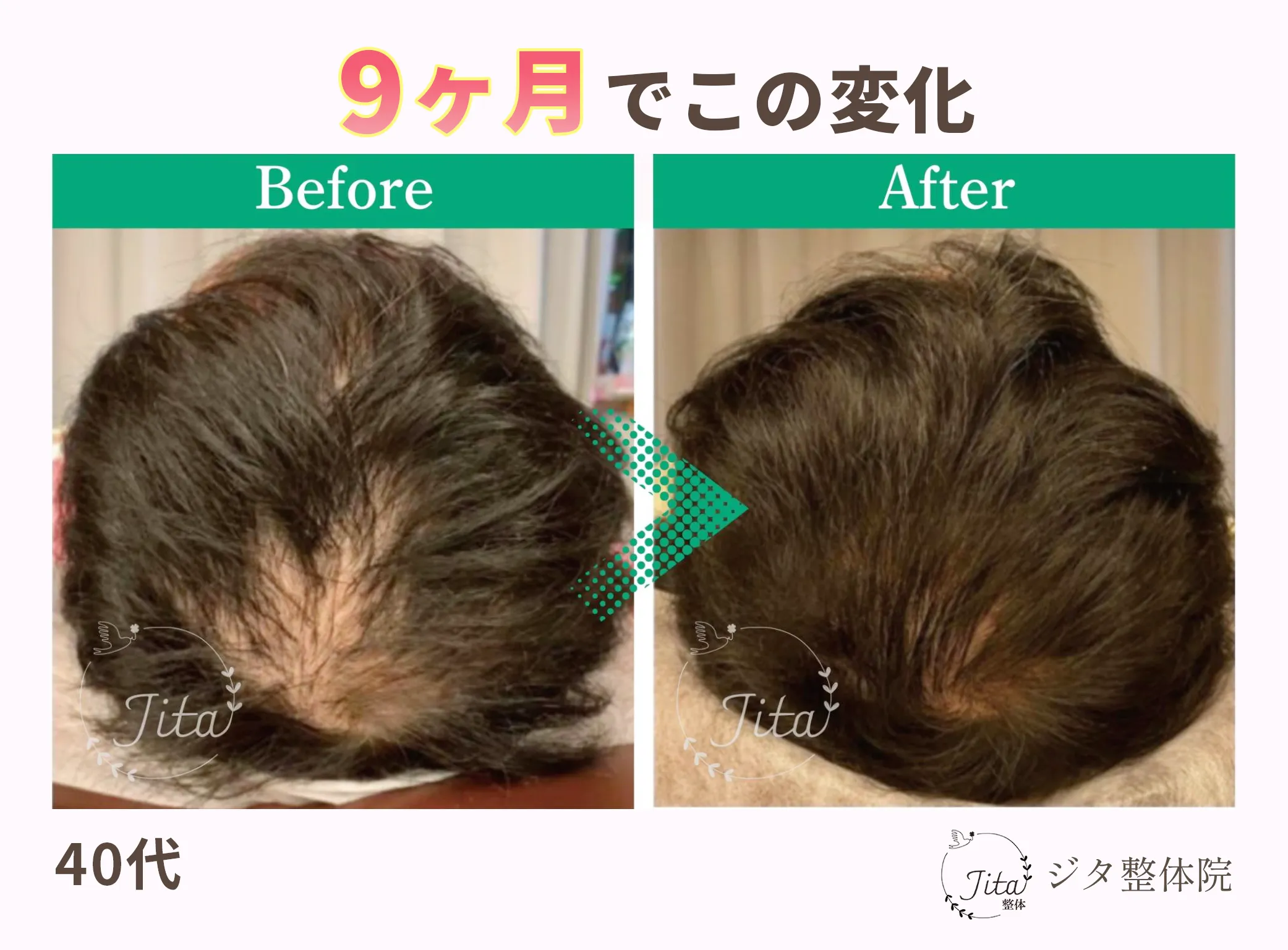 育毛施術のビフォーアフター