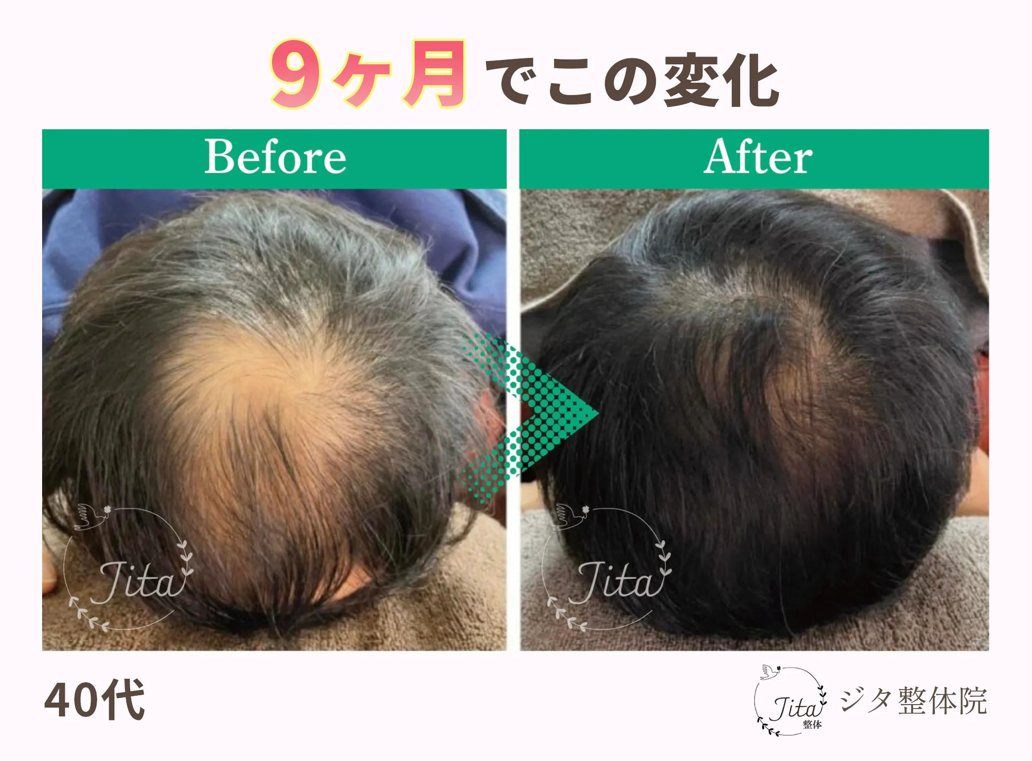 育毛施術のビフォーアフター