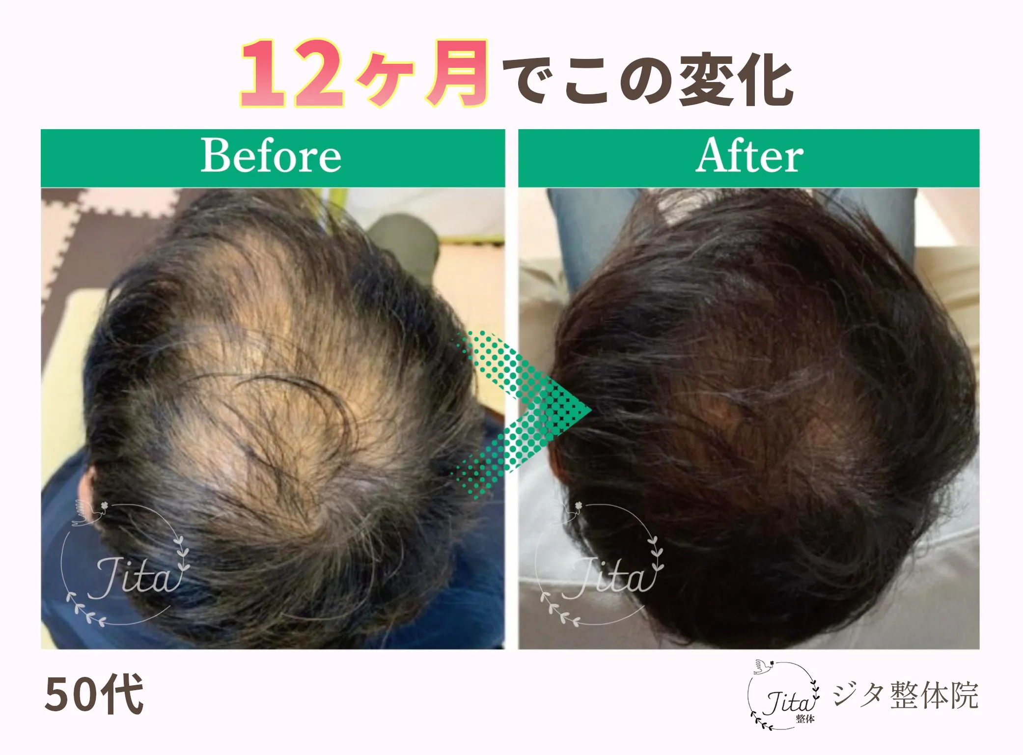 育毛施術のビフォーアフター