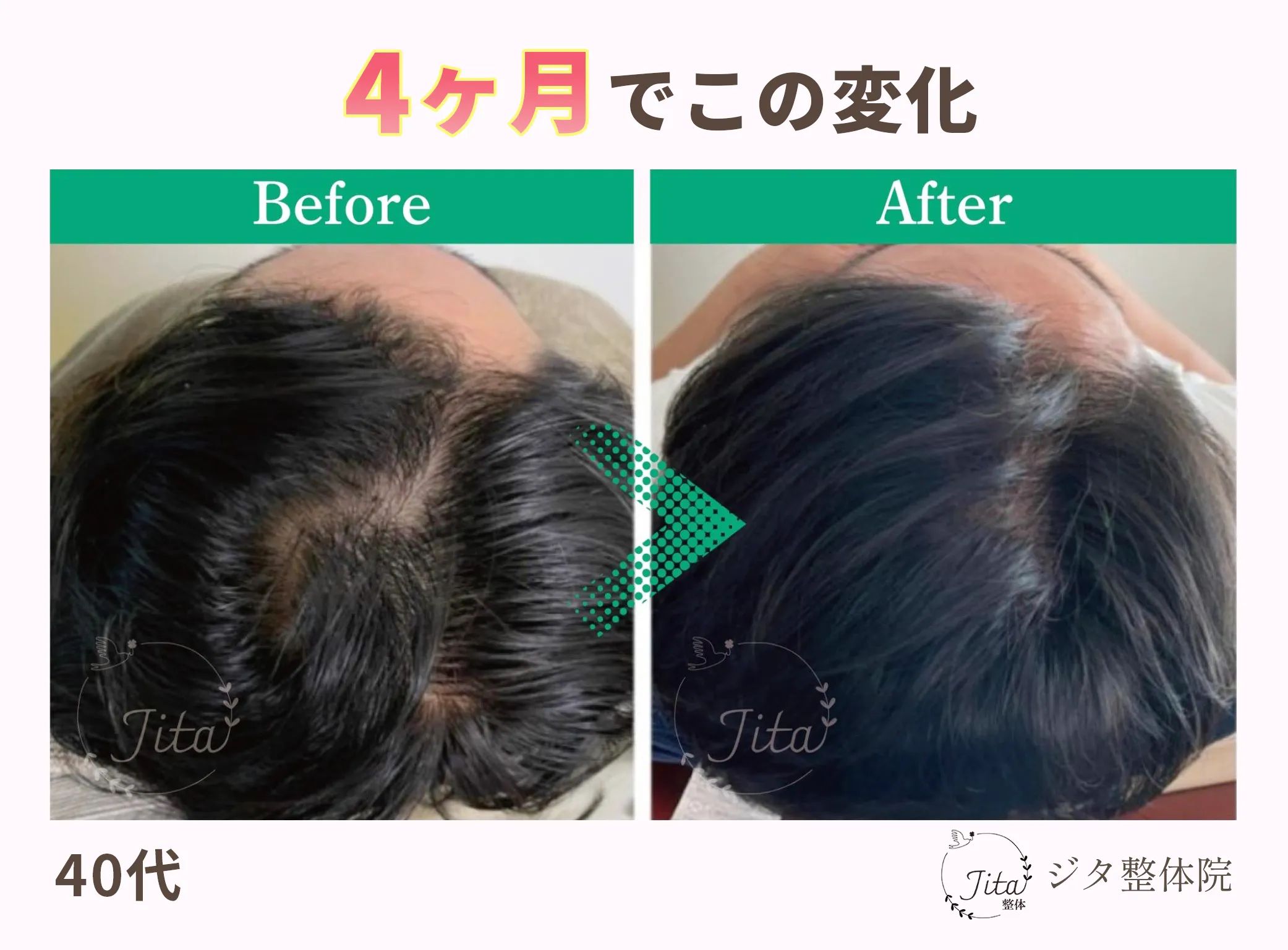 育毛施術のビフォーアフター