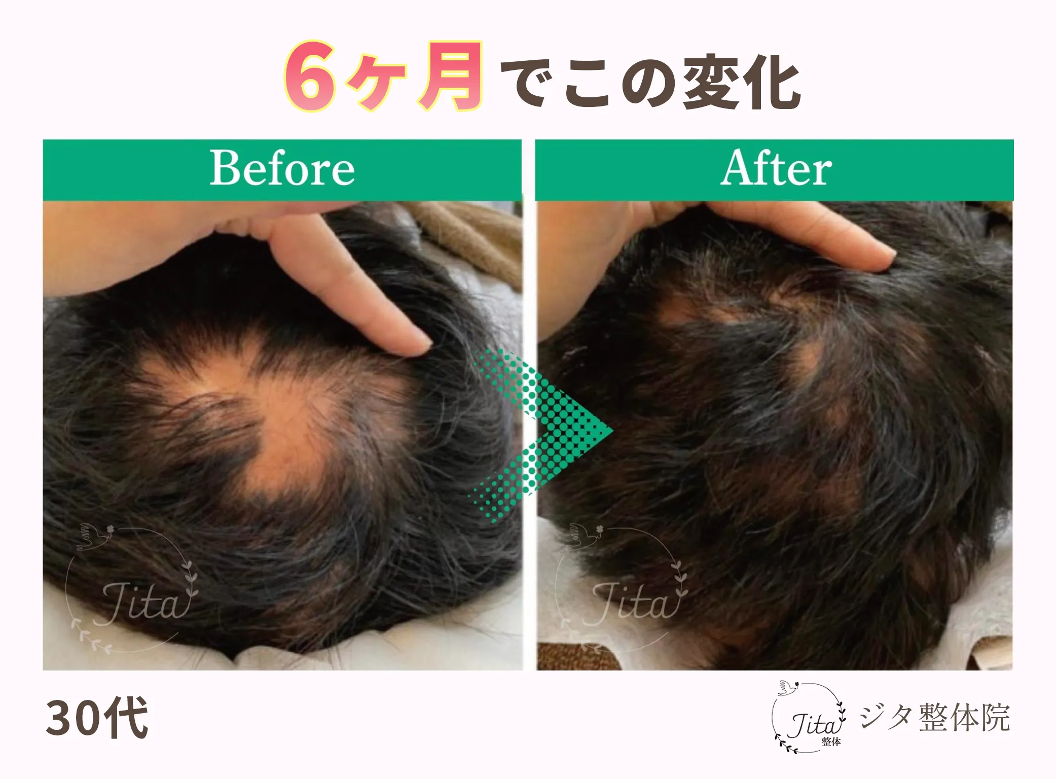 育毛施術のビフォーアフター